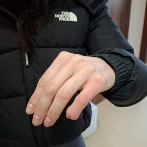 protesi di dita