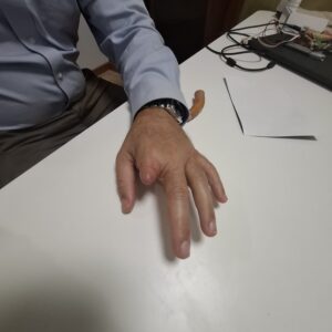 protesi di dita