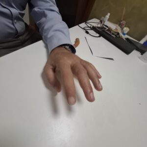 protesi di dita