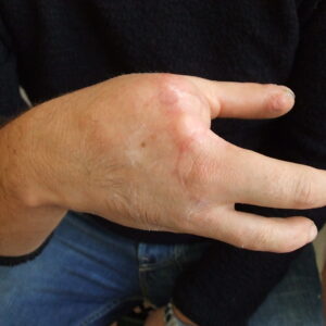 protesi di mano