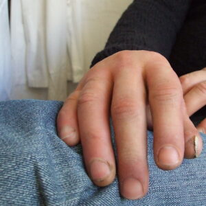 protesi di mano
