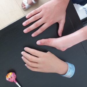 protesi di mano