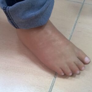 protesi di piede